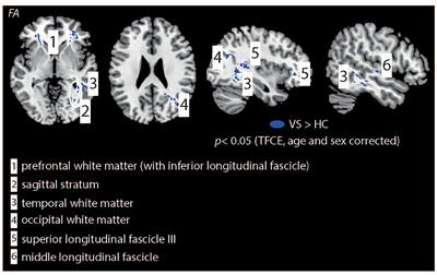 Widespread White Matter Alterations in Patients With Visual Snow Syndrome